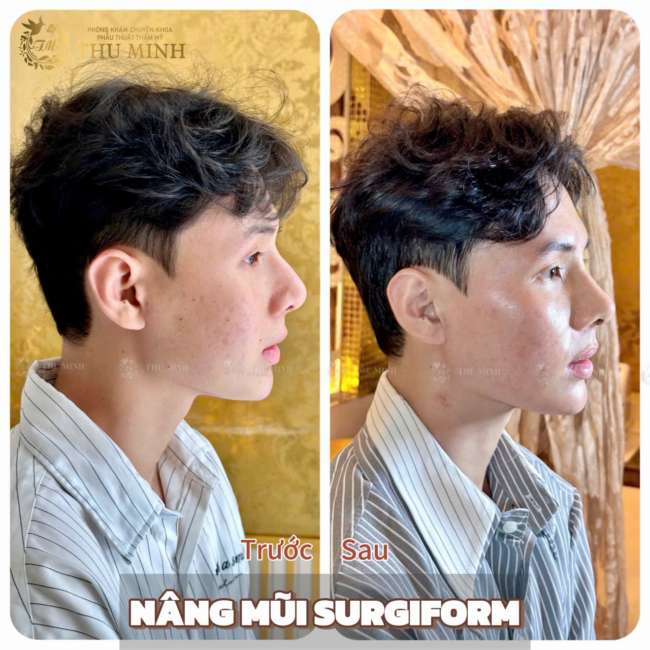 Nâng Mũi Cấu Trúc Surgiform