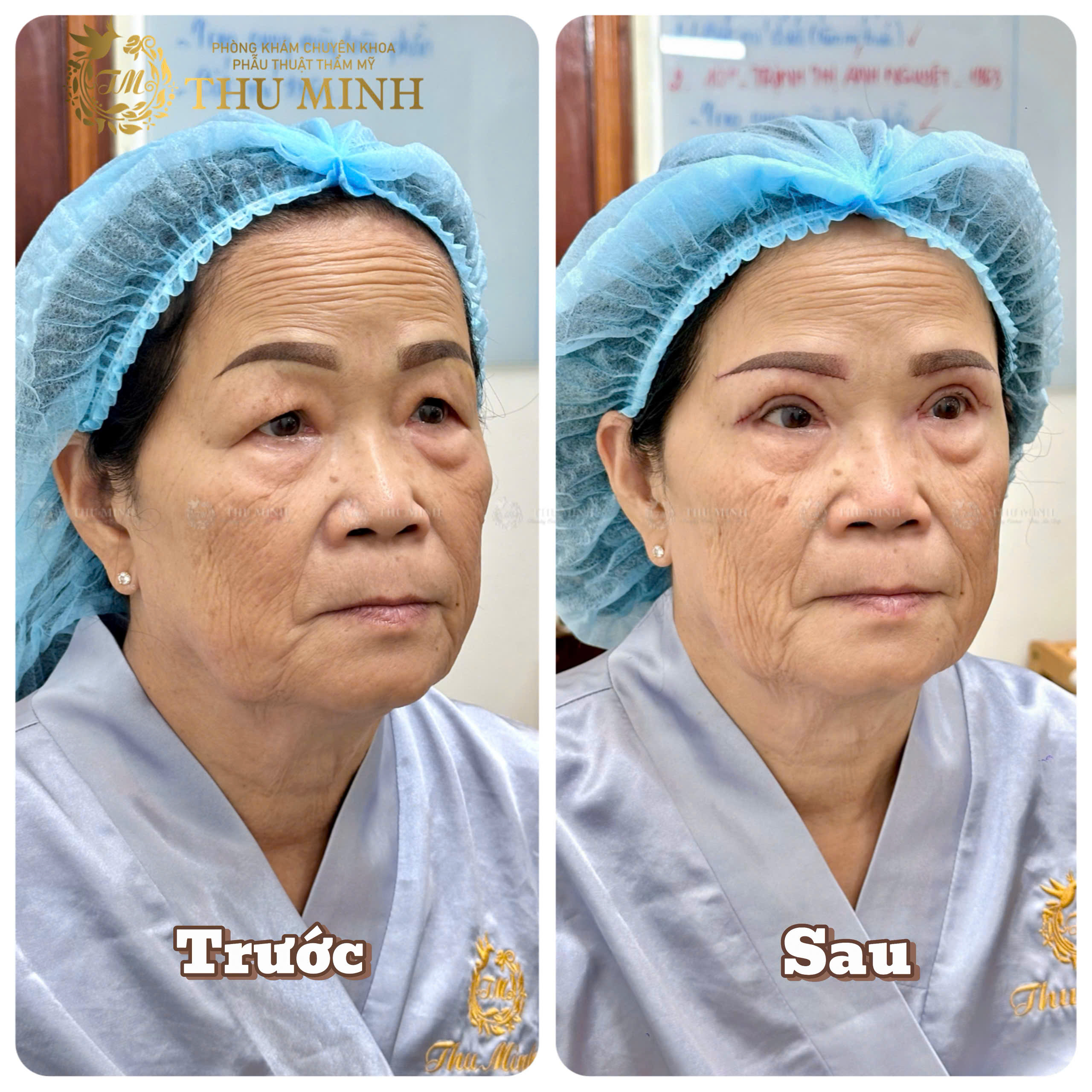 Cắt Mí Mắt
