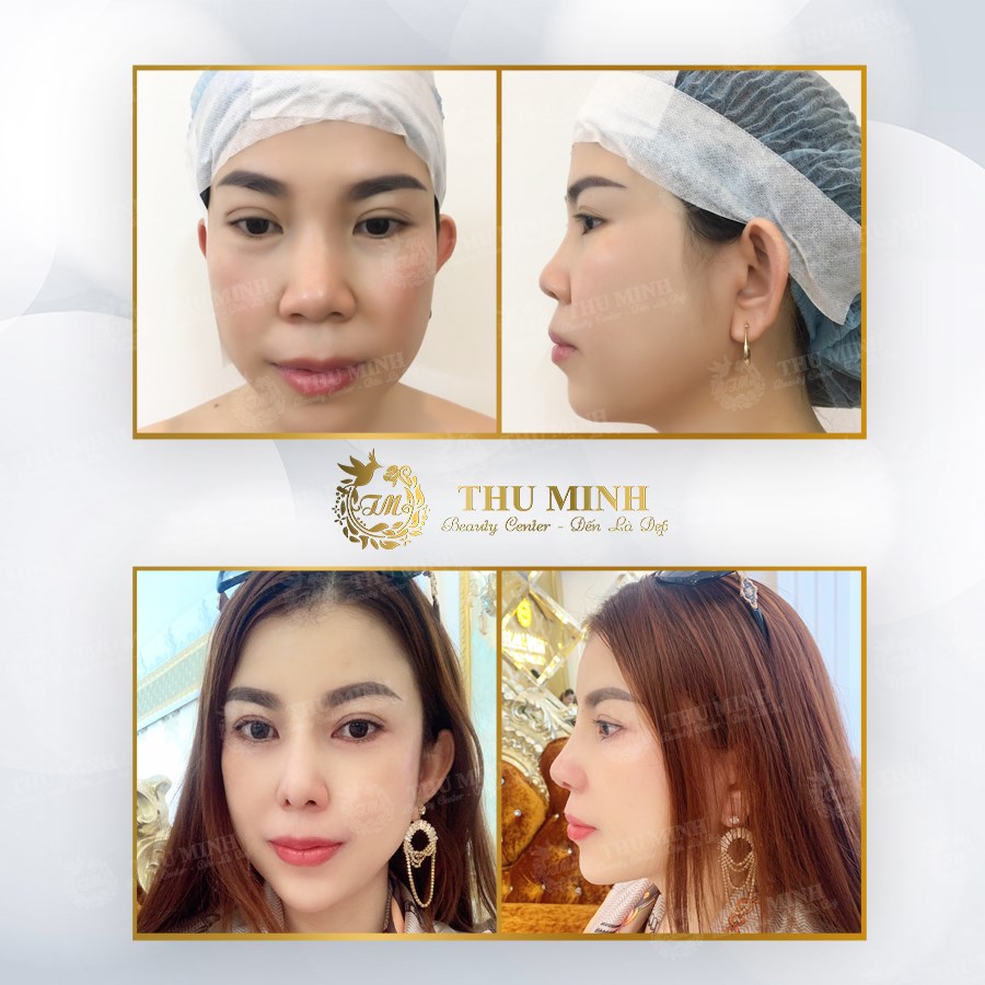 nâng chân mũi xệ