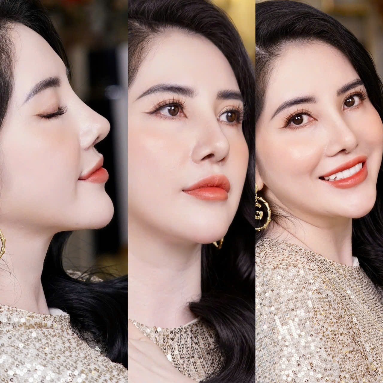 Nâng Mũi Cấu Trúc Surgiform