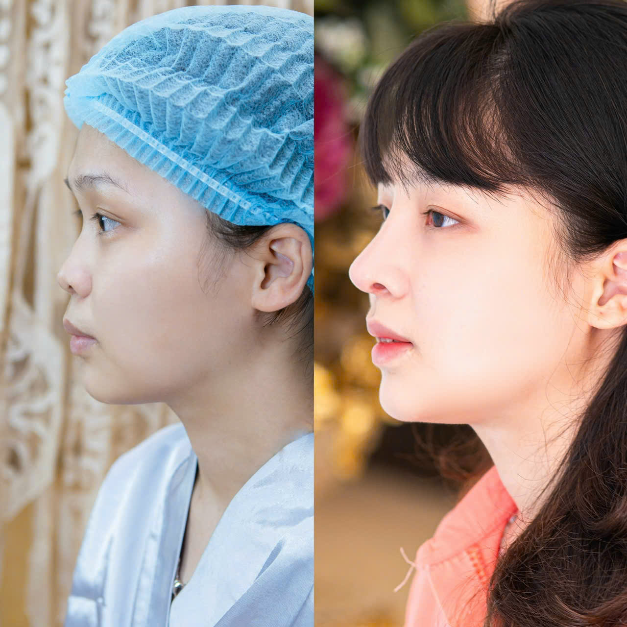 Nâng Mũi Cấu Trúc Surgiform