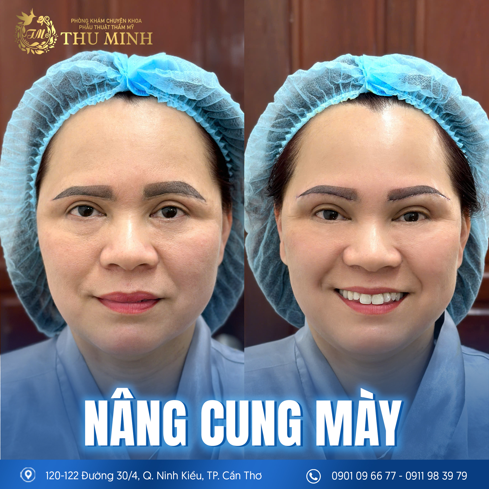 CÁCH CHĂM SÓC SAU KHI NÂNG CUNG CHÂN MÀY: SAU 1 THÁNG HỒI PHỤC NHANH, KHÔNG ĐỂ LẠI SẸO