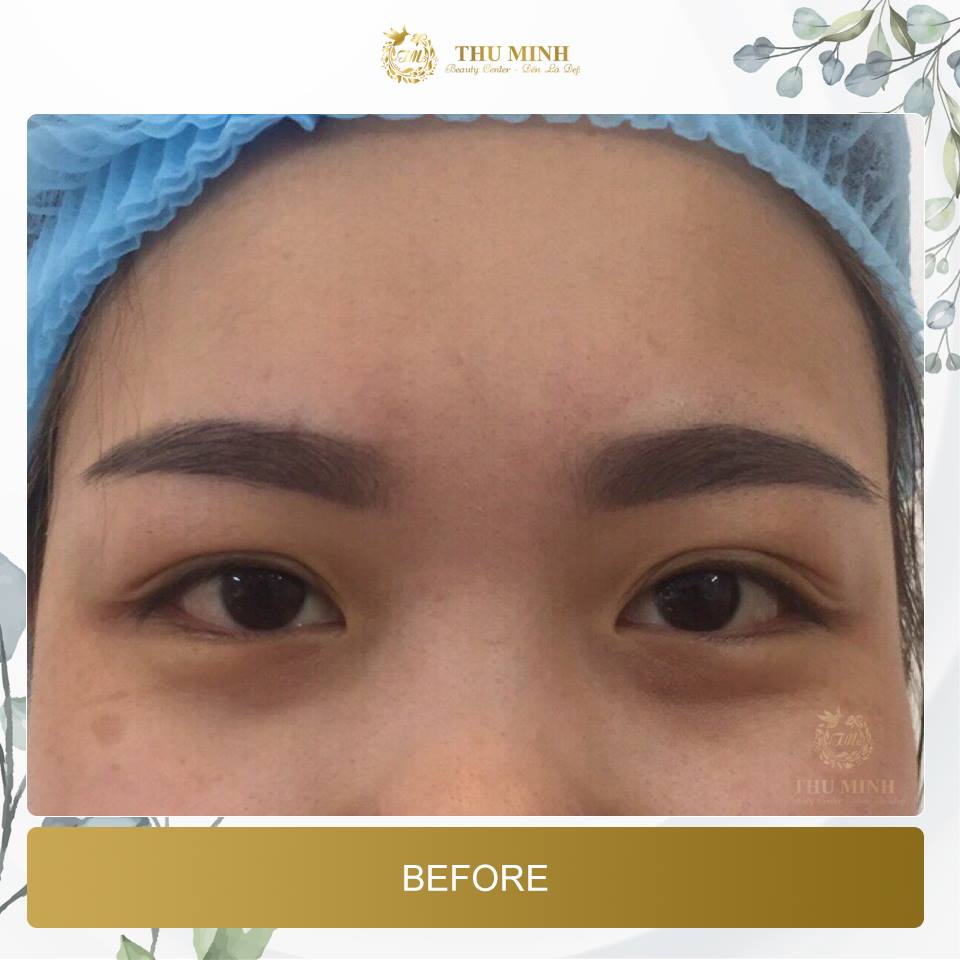 mở rộng khoé mắt