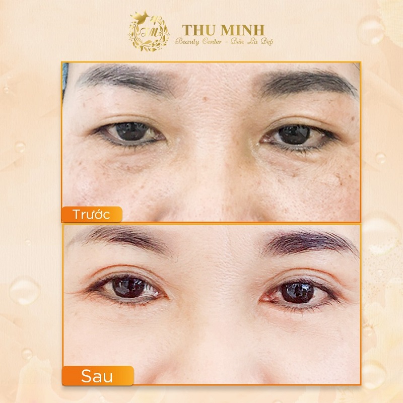 cắt mắt mí dưới