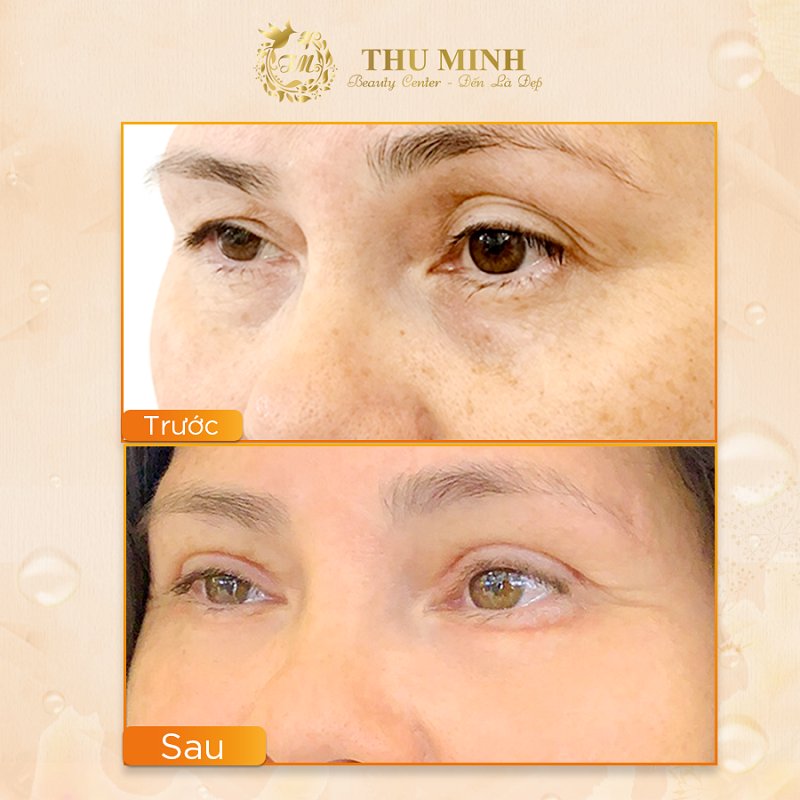 cắt mắt mí dưới