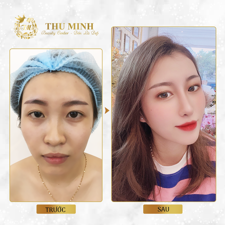 Chăm sóc mũi sau khi nâng