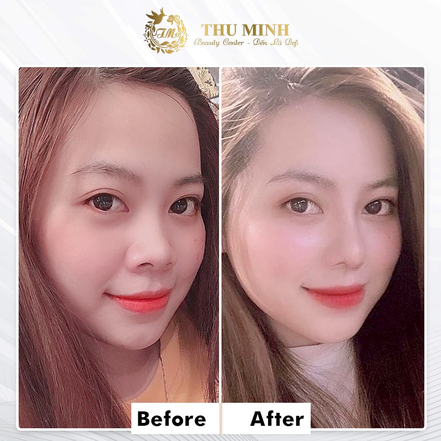 Chăm sóc mũi sau khi nâng