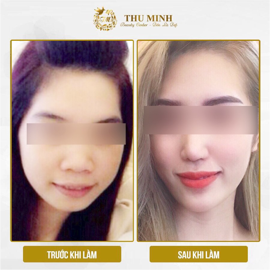 cằm thon gọn, mặt chuẩn vline