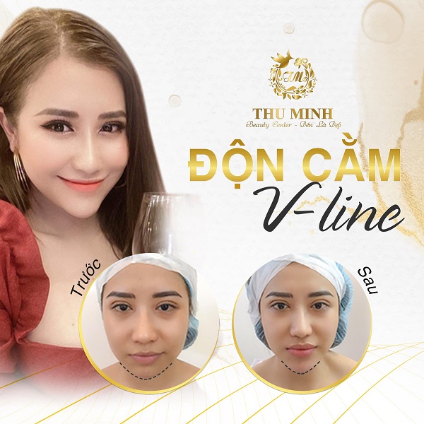 Độn Cằm V Line