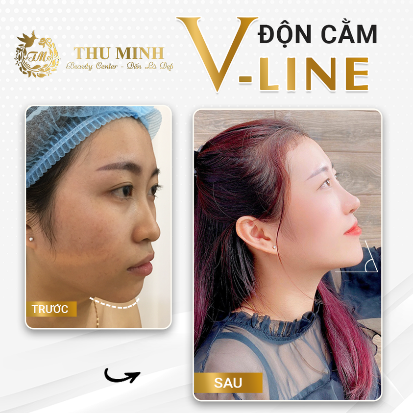 cằm thon gọn, mặt chuẩn vline