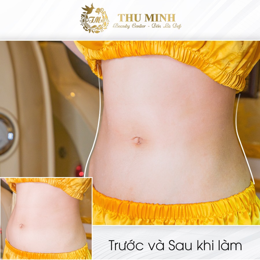 giảm mỡ bụng Lipo