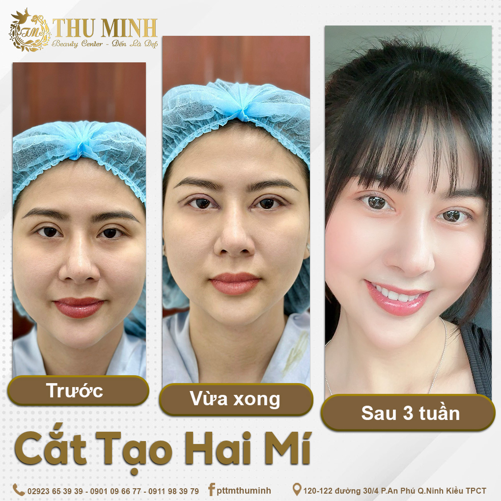 PHƯƠNG PHÁP TẠO HÌNH MẮT 2 MÍ TỰ NHIÊN TẠI PHÒNG KHÁM CHUYÊN KHOA PHẪU THUẬT THẨM MỸ THU MINH