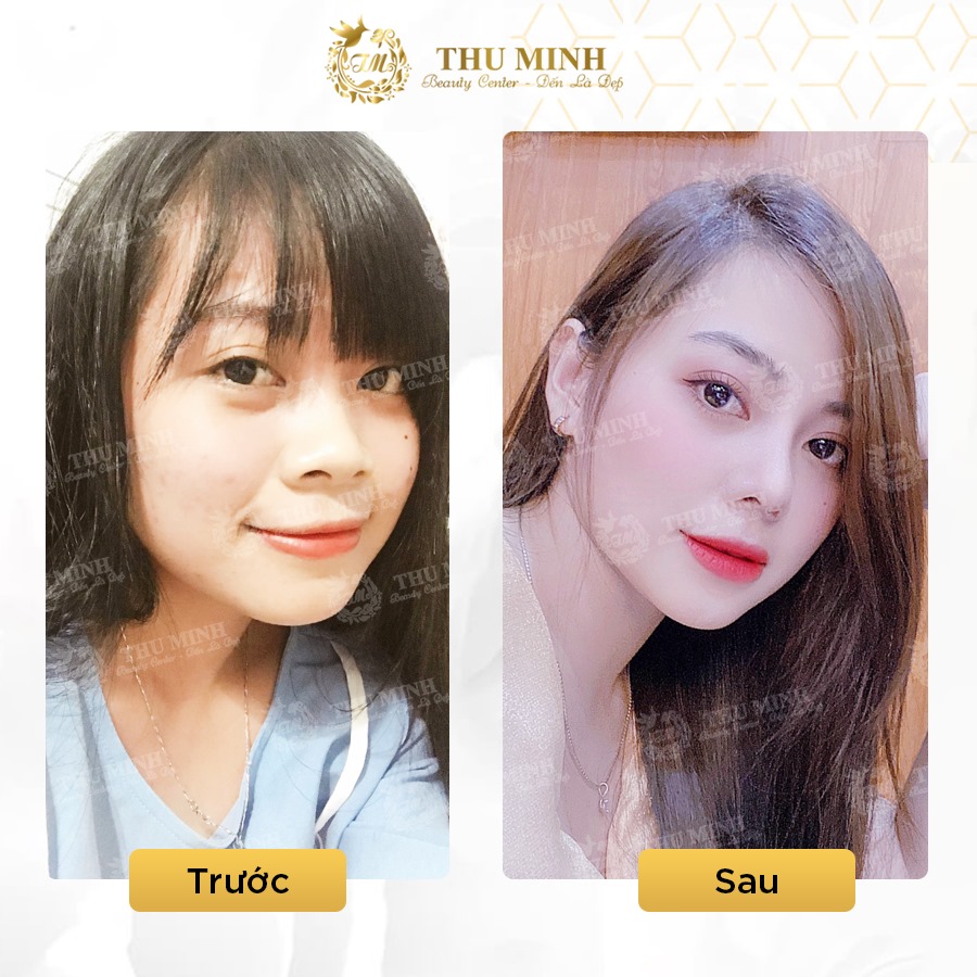 thu gọn cánh mũi