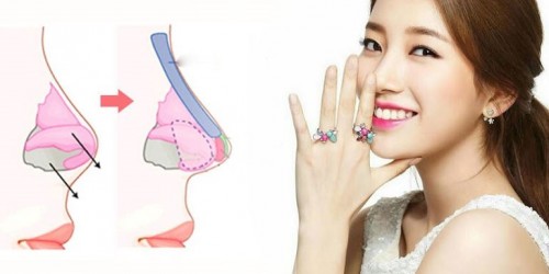 Nâng mũi bọc sụn bằng sụn tự thân hoặc sụn nhân tạo cao cấp