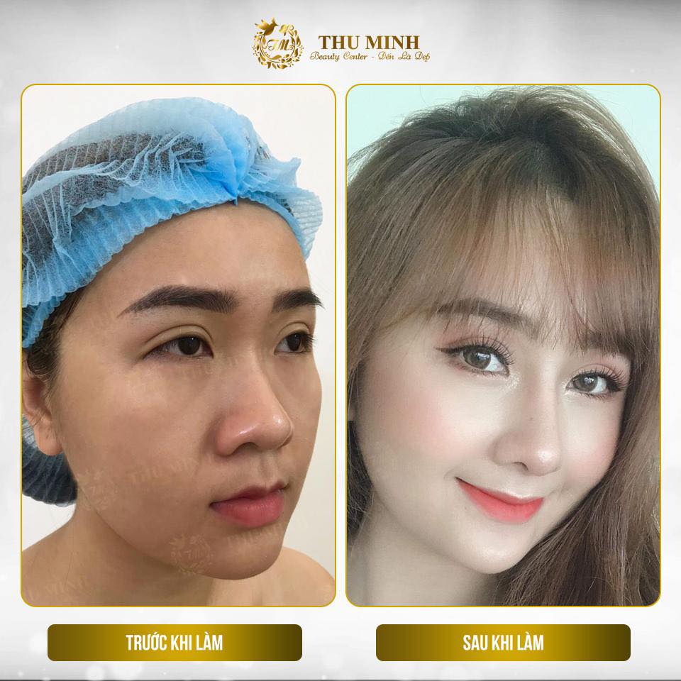 [Cập nhật 2020] Nâng mũi cấu trúc S line bao nhiêu tiền?