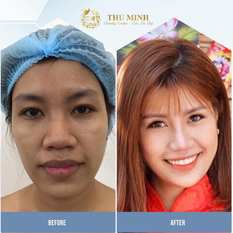 [Cập nhật 2020] Nâng mũi cấu trúc S line bao nhiêu tiền?