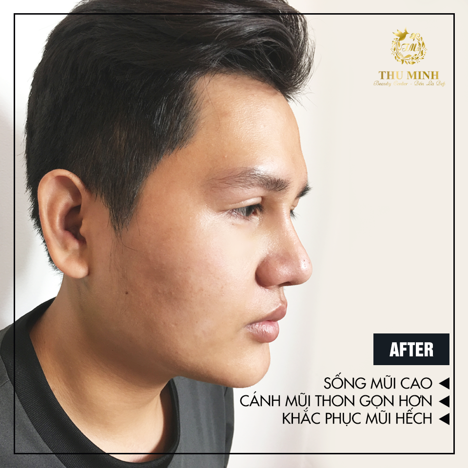 nang-mui-cau-truc-s-line-bao-nhieu-tien1