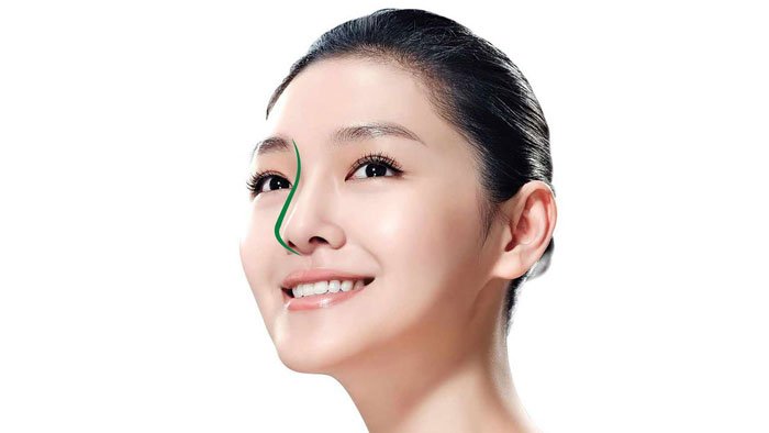 Nâng mũi Sline là gì, có đẹp không