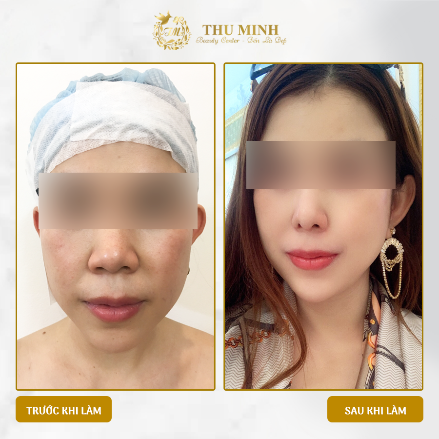 Thu Gọn Đầu Mũi Và Cánh Mũi